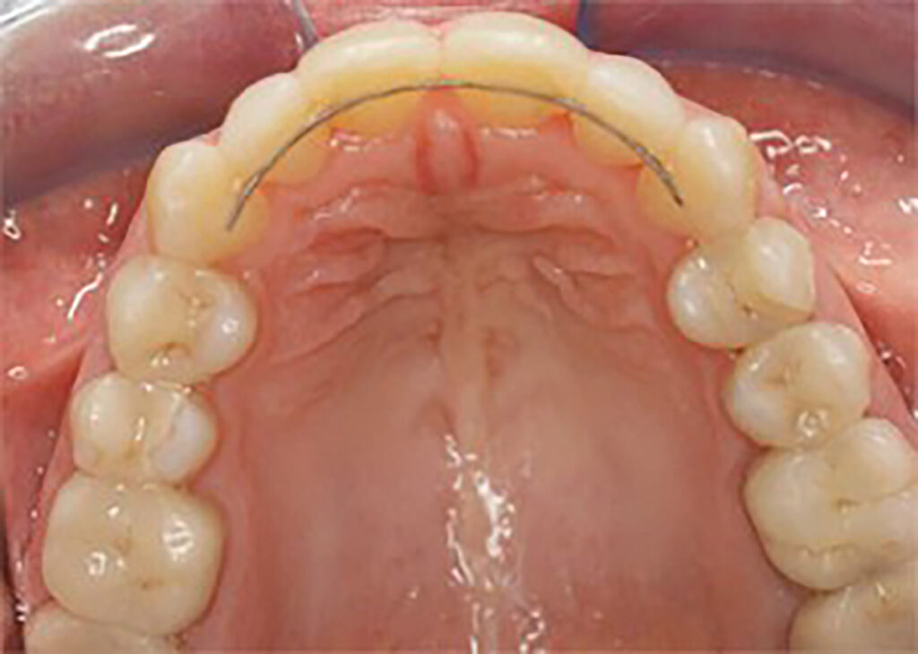 Contention orthodontie docteur Marc Gérald Choukroun 51 avenue Henri Ginoux à Montrouge